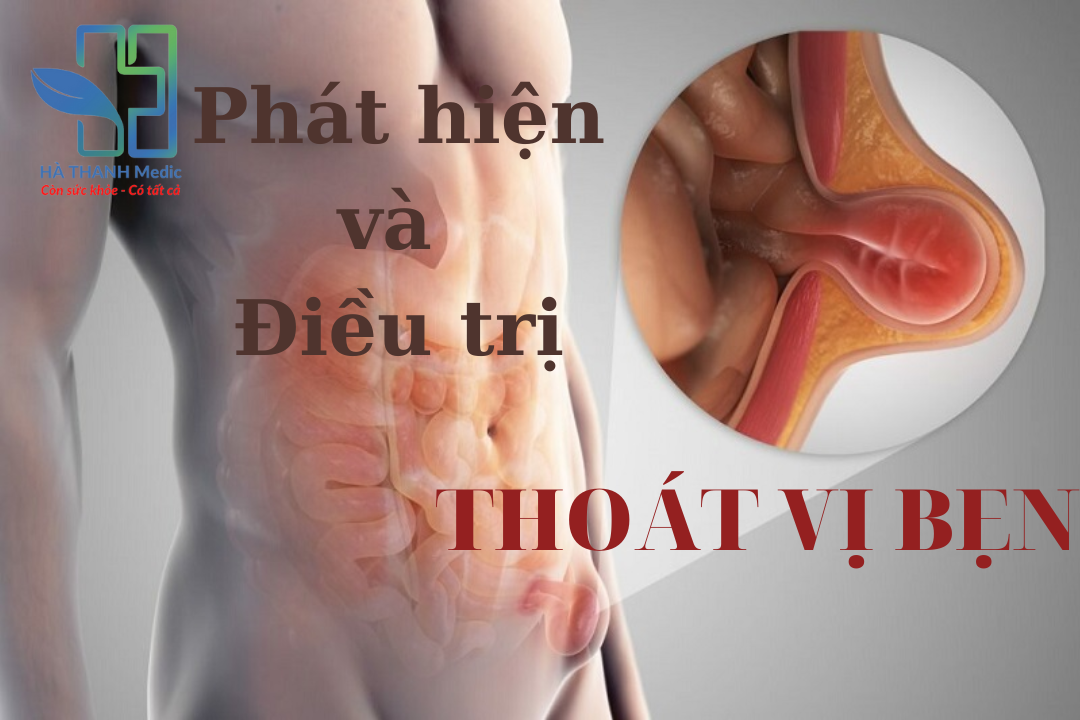điều trị thoát vị bẹn