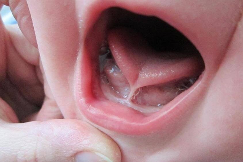 Dính thắng lưỡi ở trẻ em là gì?