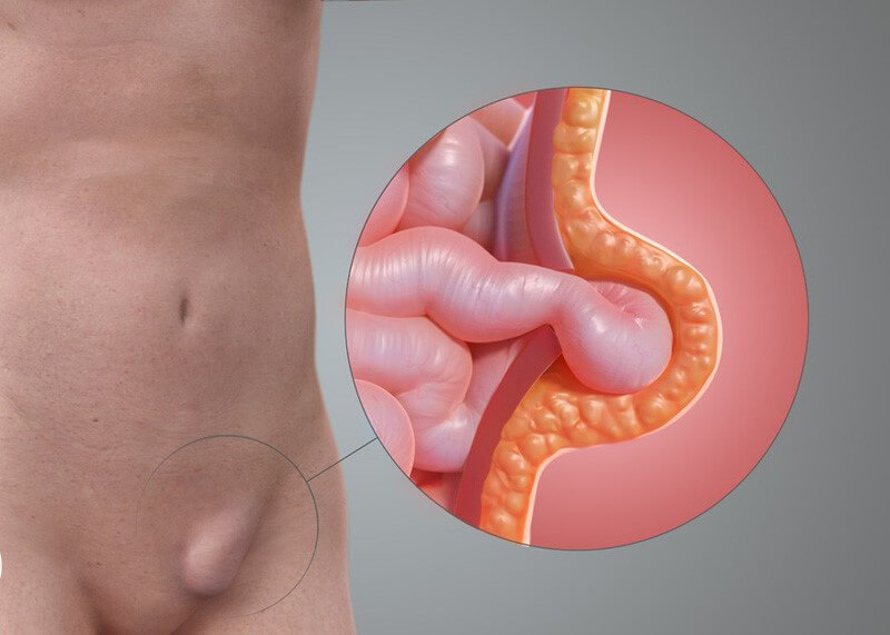 Thoát vị bẹn trên cơ thể