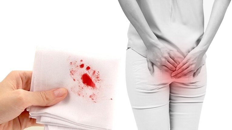 Những điều cần biết về bệnh trĩ