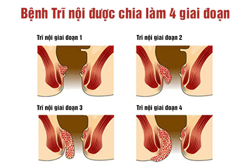 Điều trị trĩ không cần phẫu thuật ở đâu uy tín?