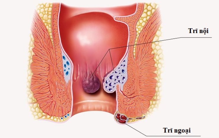 Điều Trị Trĩ không cần phẫu thuật tại Phòng Khám Trĩ Quy Nhơn