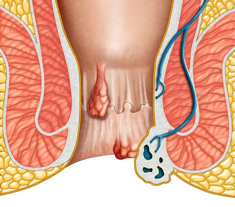 Giai đoạn nào điều trị trĩ không cần phẫu thuật?