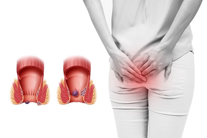 không muốn cắt trĩ có được không