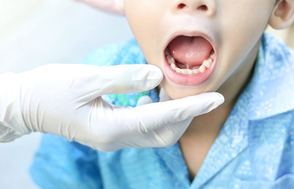 Dính thắng lưỡi ở trẻ