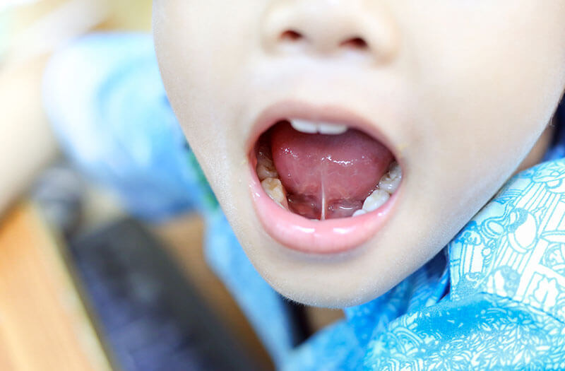 Ảnh hưởng của dính thắng lưỡi
