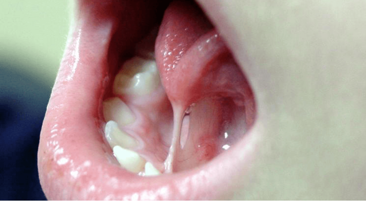 Phân loại mức độ dính thắng lưỡi ở trẻ em