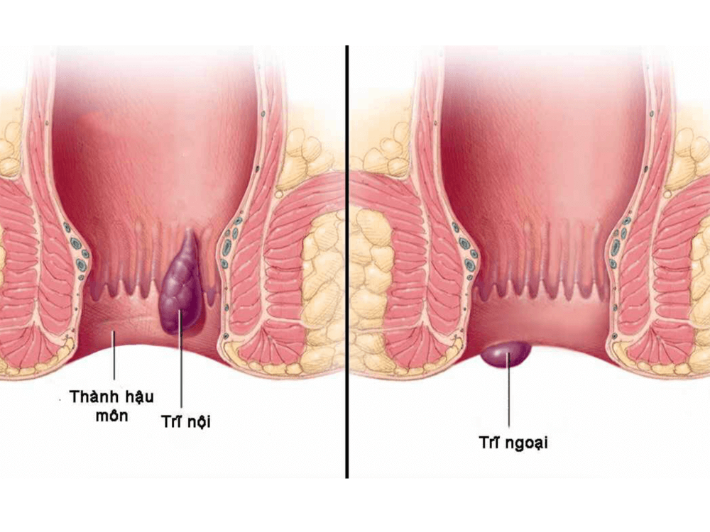 Bị trĩ có nguy hiểm không? 