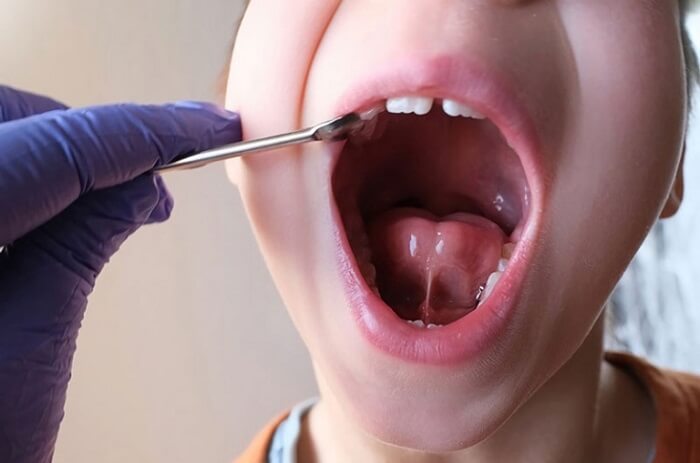 Chi phí cắt thắng lưỡi