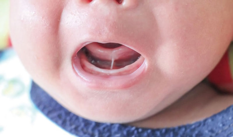 Địa chỉ cắt thắng lưỡi uy tín tại Quy Nhơn