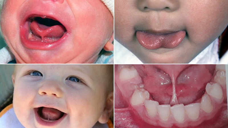 Dính thắng lưỡi mức độ nặng
