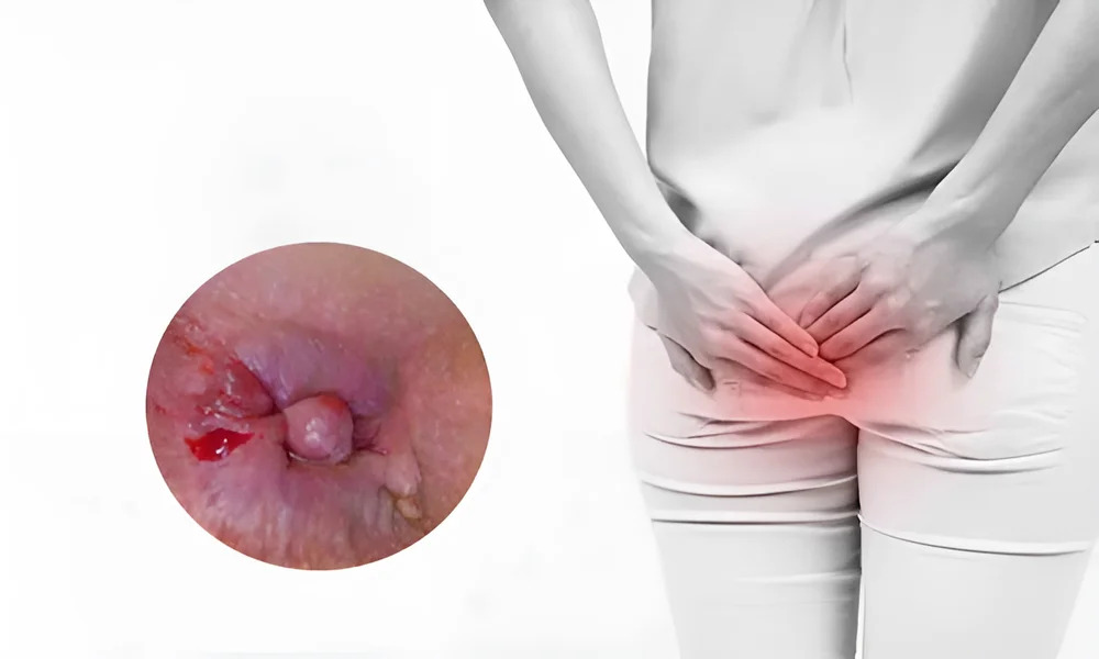 Điều trị trĩ bằng laser là gì? Khi nào nên điều trị trĩ bằng laser?