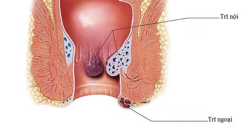 Trĩ nội và trĩ ngoại khác nhau thế nào? 