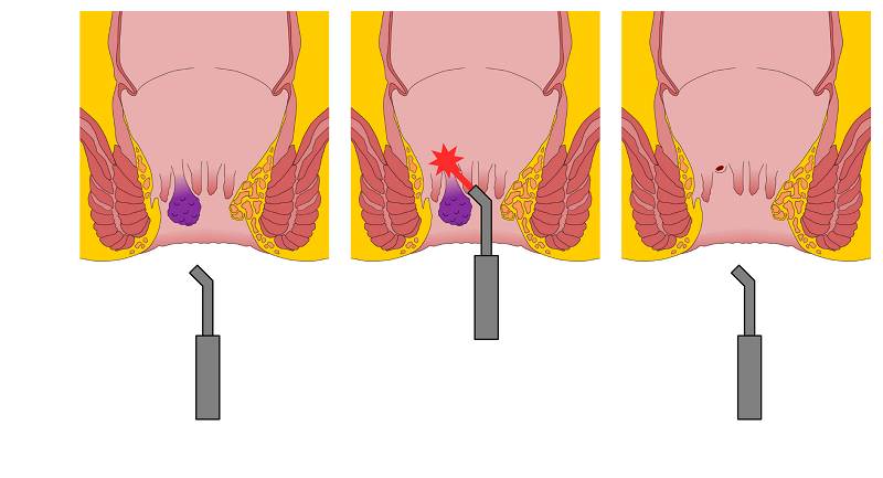 So sánh điều trị trĩ bằng laser và các phương pháp truyền thống