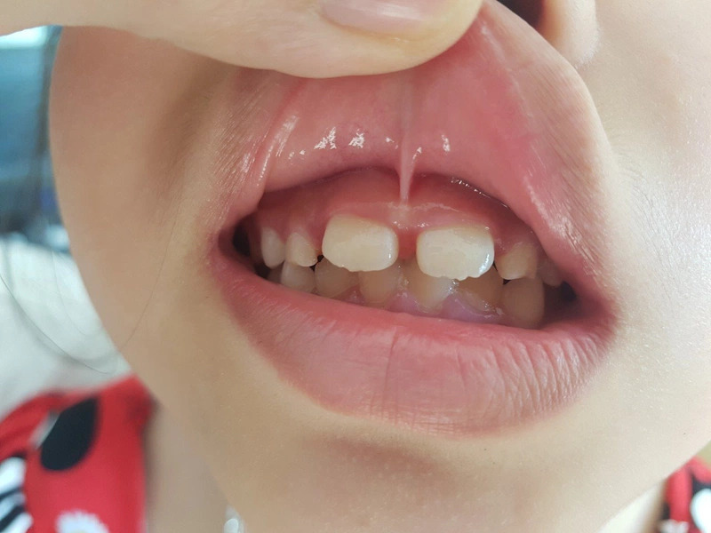 Thắng lưỡi ngắn ở trẻ