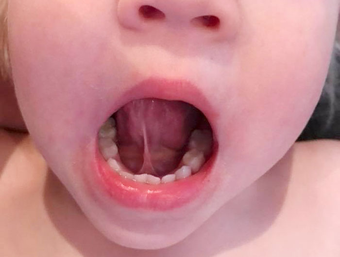 Dính thắng lưỡi là gì? Dấu hiệu nhận biết trẻ sơ sinh cần can thiệp sớm